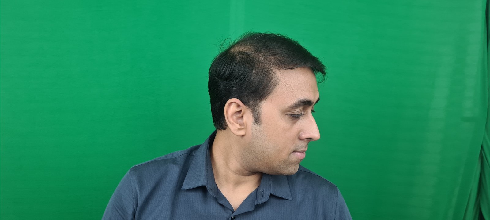 Utsav Aman After Hair Transplant